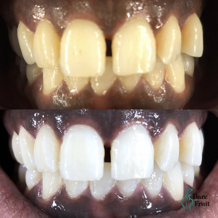 Before and after tooth whitening teeth whitening service treatment from Bare Fruit Long Island