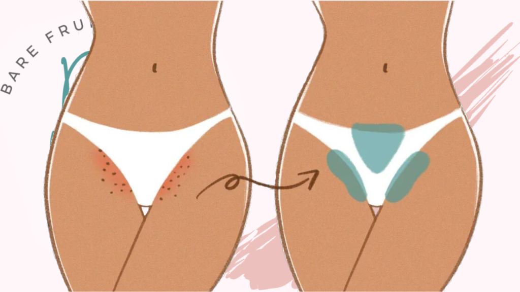 Vajacial Cartoon with ingrowns on bikini line on the left and on the right treated area does cleared up with Bare Fruit Logo in background