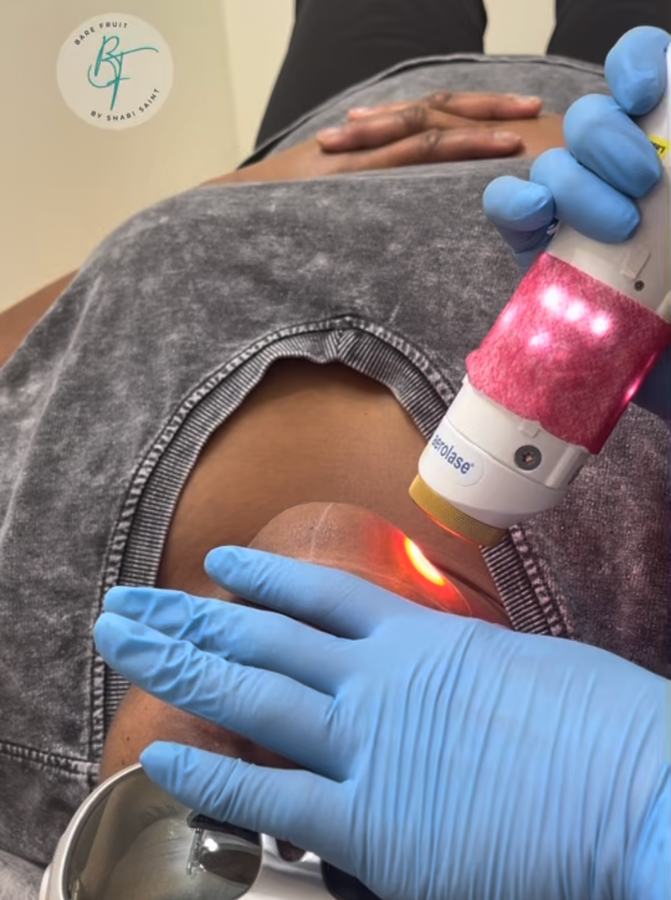 woman receiving Laser Hair Removal on her chin